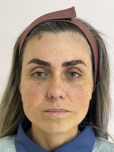 Nuze depois da harmonização facial